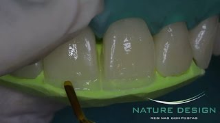 Fechamento de Diastema e Aumentos Incisais [upl. by Uni]