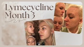 ACNE MONTH 3 ON LYMECYCLINE [upl. by Huntley]