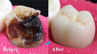 Incredible Restoration Of Tooth By Root Canal And Zirconia Crown [upl. by Martinic]