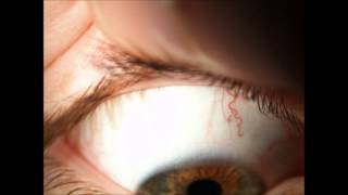 Contact Lenses  SCL Assessment of fit amp Removal [upl. by Sender34]