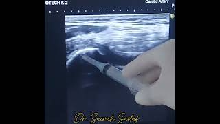 intraarticular Knee injection for OA knee joint by Dr Sairah Sadaf [upl. by Gleeson]