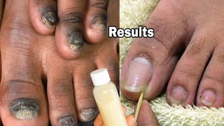 FUNGAL NAIL TREATMENT SUPER EFFECTIVE BEST TOENAILS FUNGAL SECRET [upl. by Eerak]