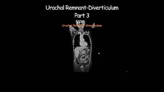 Urachal RemnantDiverticulum Part 3 radiology radiologist embryology urinarybladder [upl. by Leiso519]