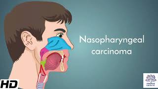 Nasopharyngeal carcinoma Causes Signs and Symptoms Diagnosis and Treatment [upl. by Halla]