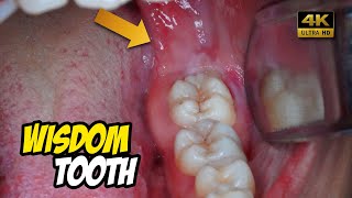 Removal of horizontal impacted wisdom tooth  Odontectomy  Dentist  Dokter Gigi Tri Putra [upl. by Ayn]