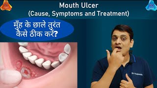 Mouth Ulcer  Treatment for Immediate Relief By Dr Puspendra [upl. by Adnorahc]