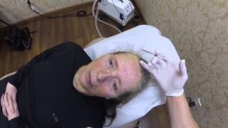 Botox Injections Brow Lift  Huntington Long Island NY Plastic Surgeon [upl. by Ripleigh]