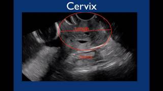 Pelvic Ultrasound [upl. by Floris]