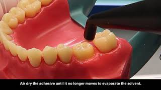 3M™ RelyX™ Ultimate Adhesive Resin Cement Application Video [upl. by Anah]