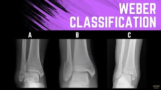 Weber Classification Ankle Fractures [upl. by Mcbride]