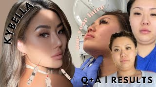 KYBELLA QA  1 year later recap  WELCOME BACK to my new beauty blog kybella kybellaresults [upl. by Yelnik856]