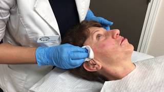 PDO Thread Lift  Non Surgical Better Than Botox  Revivify Medical Spa Beaumont TX [upl. by Nikolai477]