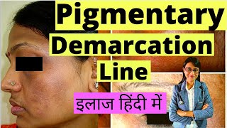 quotDr plz help how to get rid of Pigmentary Demarcation Line 🙄quot Dr Rupal Explains 2020 [upl. by Elehcin]