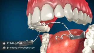 Jaw Surgery for Teeth Alignment  Fixing Jaw Braces [upl. by Herzberg]