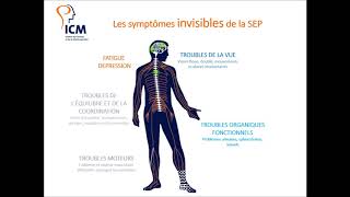 Les symptômes de la sclérose en plaques [upl. by Rufena]