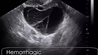 case 609 Hemorrhagic corpus luteum cyst CLC [upl. by Hogue]