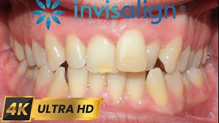 INVISALIGN treatment for 10 MONTHS 4k timelapse [upl. by Buehrer69]