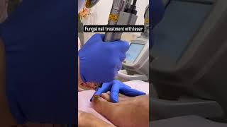 Fungal nail treatment with laser  By Dr Chandni Jain Gupta  shorts expertdermatologist [upl. by Sirovart]