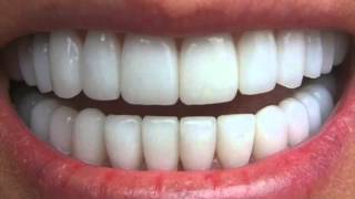 Get Perfectly Straight Teeth ―∎ affirmations  Cure Overbite Underbite amp Crossbite [upl. by Naujej]