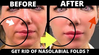 🛑 HOW TO GET RID OF NASOLABIAL FOLDS WIITH FACE YOGA  JOWLS SAGGY SKIN FOREHEAD  FACIAL MUSCLES [upl. by Gilliam]