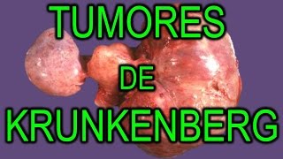 TUMORES DE KRUNKENBERG  TUMOR MALIGNO METASTÁSICO DE OVARIO [upl. by Rikki]