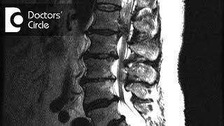 Meaning of disc protrusion with facet joint arthropathy in MRI  Dr Kodlady Surendra Shetty [upl. by Elleinwad824]