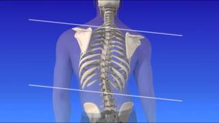 Scoliosis  Curvature of the Spine [upl. by Htial]