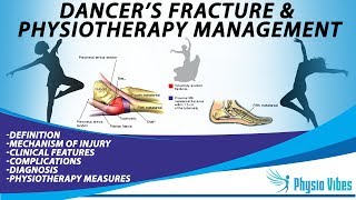 DANCERS FRACTURE amp PHYSIOTHERAPY MANAGEMENT [upl. by Lunn]