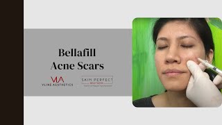 Bellafill  Acne Scars [upl. by Shaughnessy994]