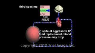 Third Spacing Fluid Response to Surgical Stress video  Animation by Cal Shipley MD [upl. by Apur]