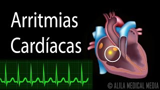 Arritmias Cardíacas Animación Alila Medical Media Español [upl. by Troxell]