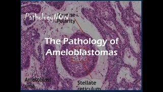 The Pathology of Ameloblastomas [upl. by Laamak]