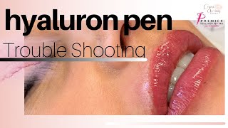 Hyaluron Pen troubleshooting retention and lumps [upl. by Belcher]