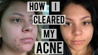 How I Cleared My Acne  Skin Care Routine For Oily Acne Prone Skin [upl. by Adnerad475]