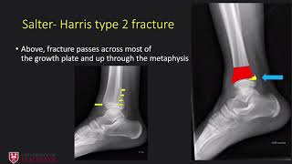 Paediatric plain film trauma imaging [upl. by Namreg]