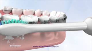 How to use your Philips Sonicare Toothbrush perfect for braces too [upl. by Ettevram]