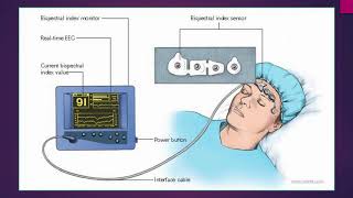 Bispectral index in hypercapnic encephalopathy  Video abstract ID 167020 [upl. by Ahseikan]