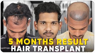 Hair Transplant in Jaipur  Best Results amp Cost of Hair Transplant in Jaipur [upl. by Aremmat]