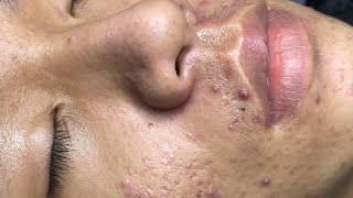 ACNE TREATMENT VU QUYNH MI Acne On Boys Chin 2024 [upl. by Josephina114]