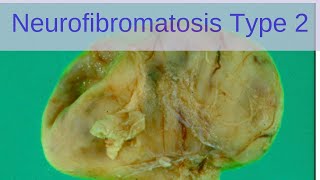 Neurofibromatosis Type 2 NF2  Pathology mini tutorials [upl. by Sherilyn507]