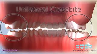 Posterior Crossbite [upl. by Telford670]