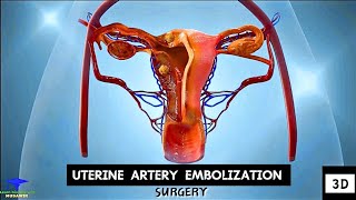 Uterine Artery Embolization  Tumor Cell Removing Surgery [upl. by Ane742]