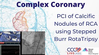 Watch Live PCI of Calcific Nodules of RCA using Stepped Burr RotaTripsy [upl. by Norrehs314]