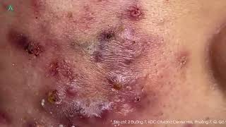 Big Cystic Acne Blackheads Extraction Blackheads amp Milia Whiteheads Removal Pimple Popping [upl. by Scrogan196]