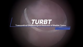 TURBT  Transurethral Electrosurgical Resection of Bladder Tumor [upl. by Montford172]