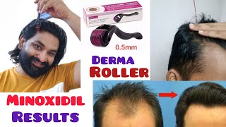 Derma Roller for Hair Growth  How to Use Derma Roller on Hairline  Minoxidil Hair Regrowth [upl. by Dirrej]