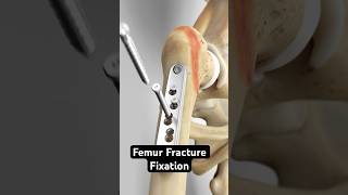 Femur Fracture Fixation Dynamic Hip Screw Method [upl. by Steere]