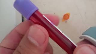 HBA1C test procedure how read HBA1C test through ichroma special biochemistry analyzer HBA1C test [upl. by Kehr634]