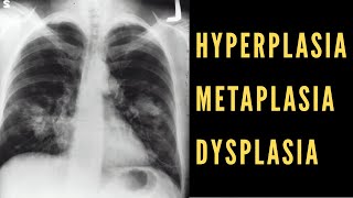 Hyperplasia Metaplasia amp Dysplasia Explained Cancer Biology [upl. by Delaney]