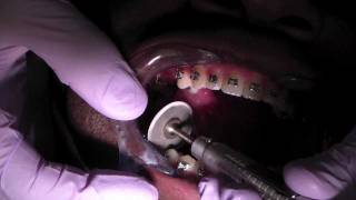 Orthodontic Interproximal Reduction [upl. by Shepley384]